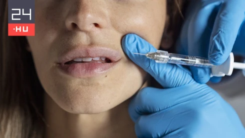 Képesítés nélkül végzett hialuronsavas ajakfeltöltéseket egy fiatal békéscsabai kozmetikus